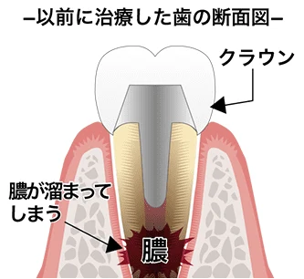 膿 断面図