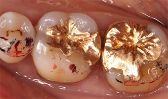金属インレー（金合金）