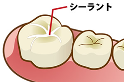 シーラント