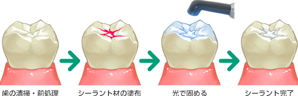 シーラントによる予防処置