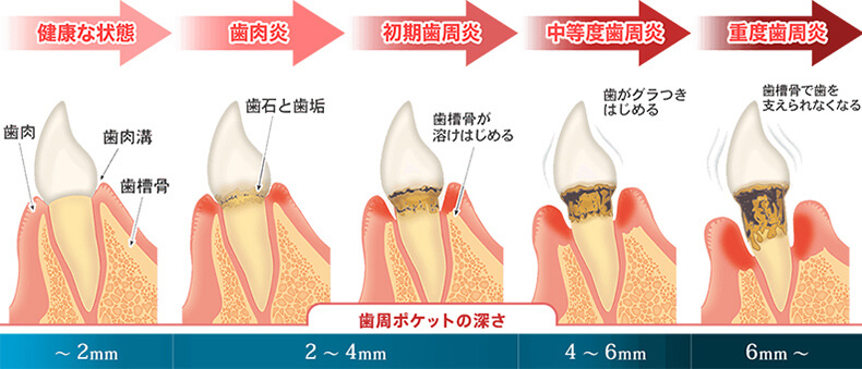 歯周病の種類と進行段階