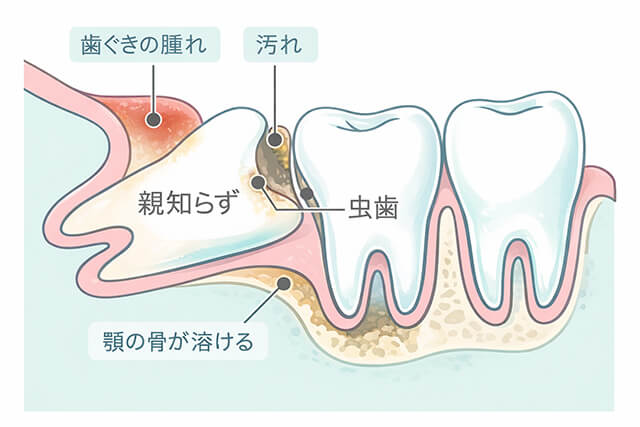 親知らずに痛みが出やすい理由