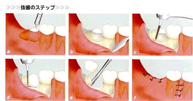 親知らずの抜歯のステップ