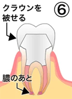 治療の流れ06