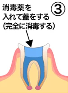 治療の流れ03