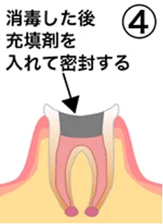 治療の流れ04
