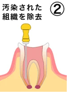 治療の流れ02
