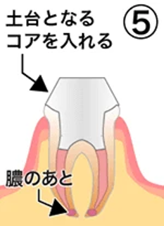 治療の流れ05
